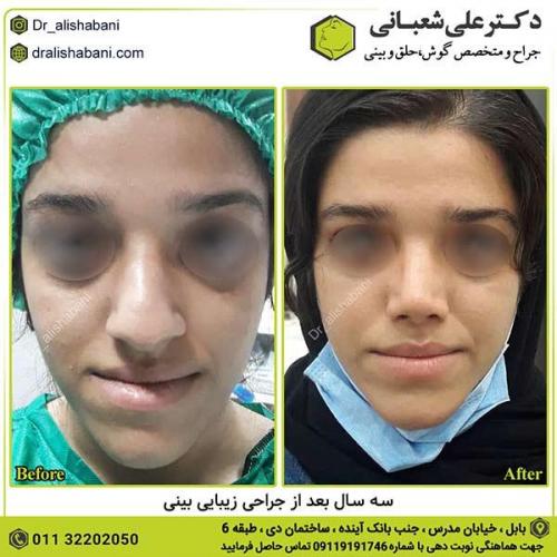 جراحی-بینی-386