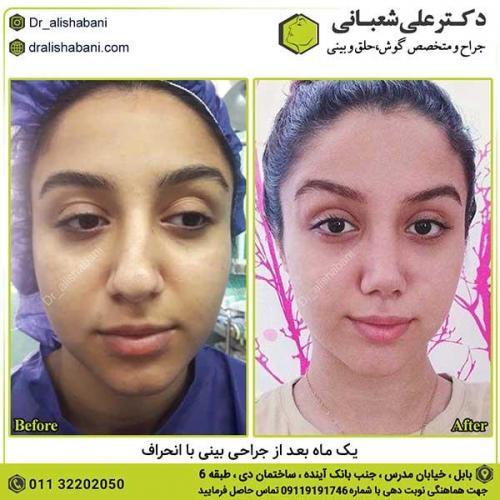 جراحی-بینی-390