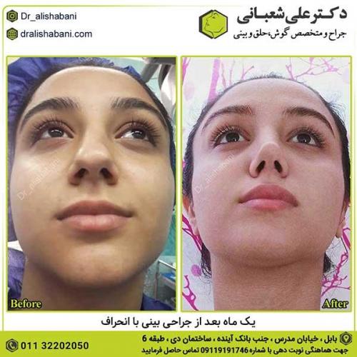 جراحی-بینی-391
