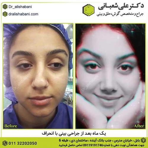 جراحی-بینی-393