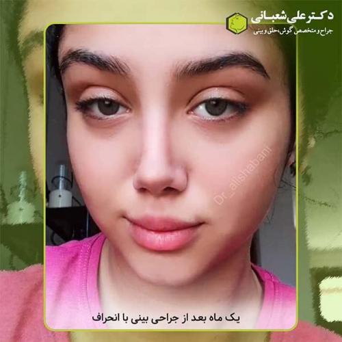 جراحی-بینی-394