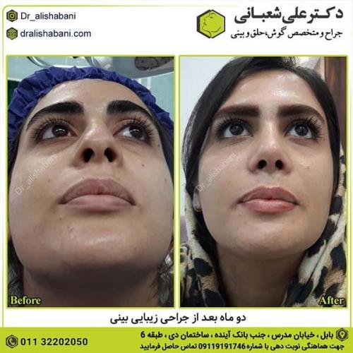 جراحی-بینی-396