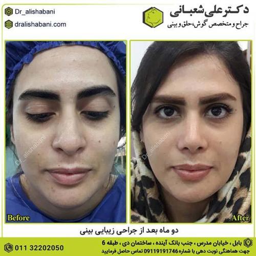 جراحی-بینی-397