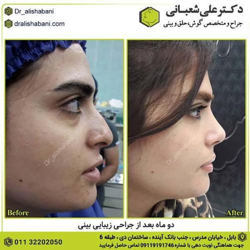 جراحی-بینی-399