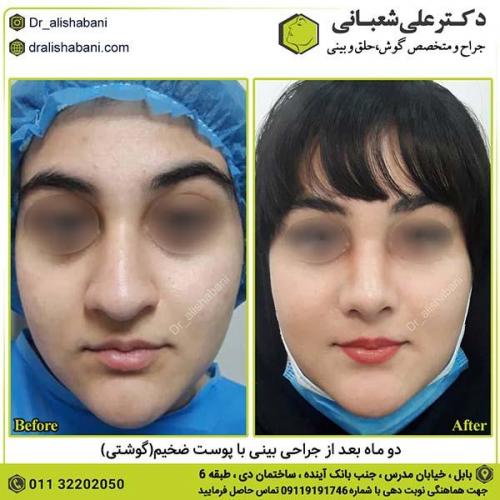 جراحی-بینی-401