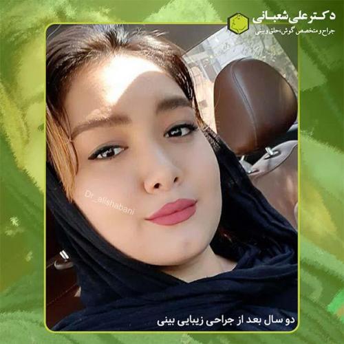 جراحی-بینی-403