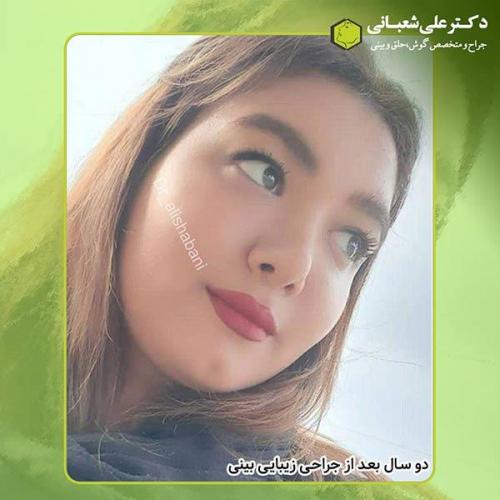 جراحی-بینی-405