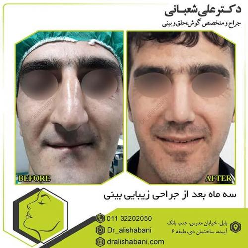 جراحی-بینی-88
