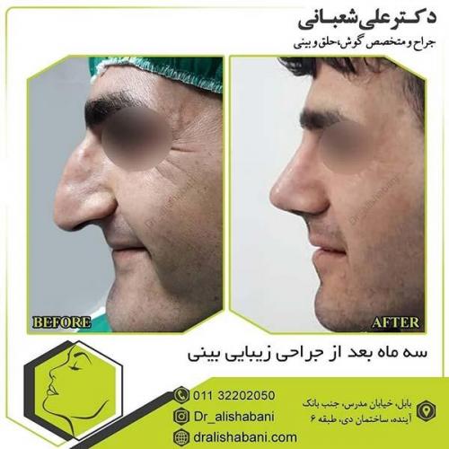 جراحی-بینی-89