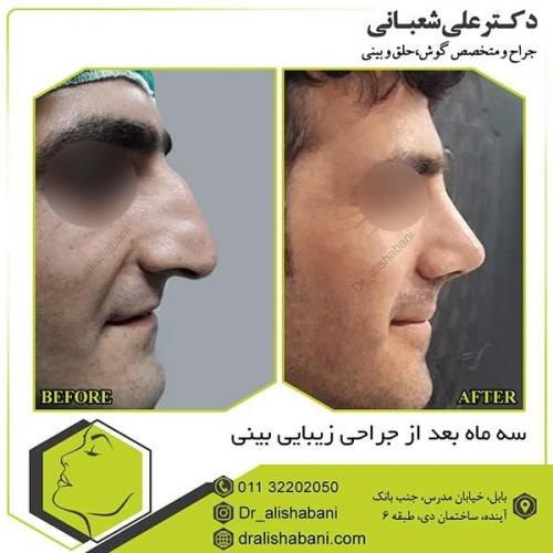 جراحی-بینی-90