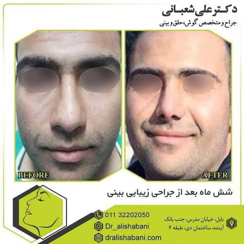 جراحی-بینی-91