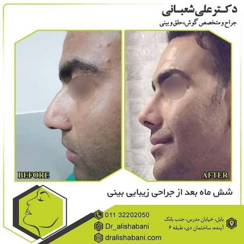 جراحی-بینی-92
