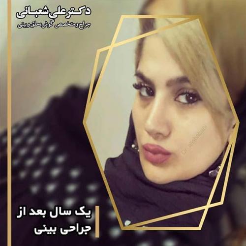 جراحی-بینی-95