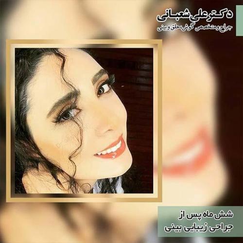 جراحی-بینی-97