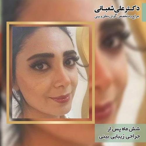 جراحی-بینی-98