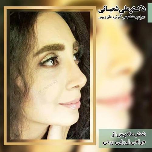جراحی-بینی-99