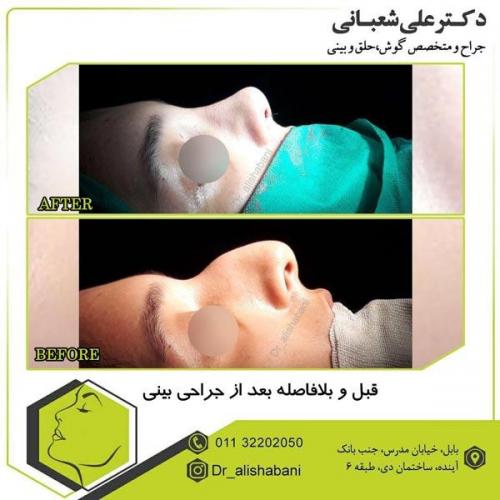 جراحی بینی 1