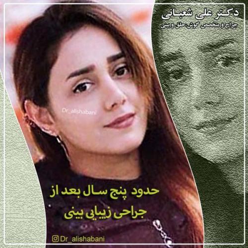 جراحی بینی 100