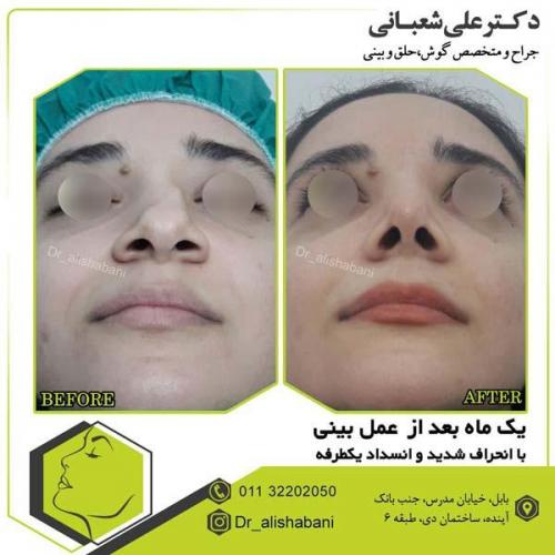 جراحی بینی 104