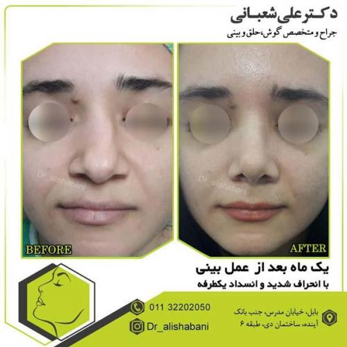 جراحی بینی 106