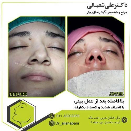 جراحی بینی 107