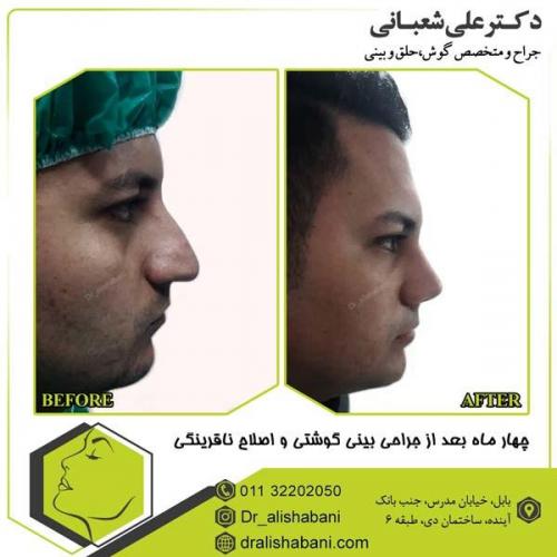 جراحی بینی 113
