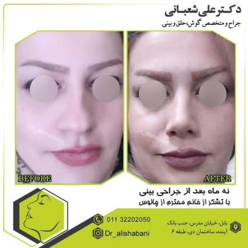 جراحی بینی 2