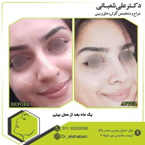 جراحی بینی 22