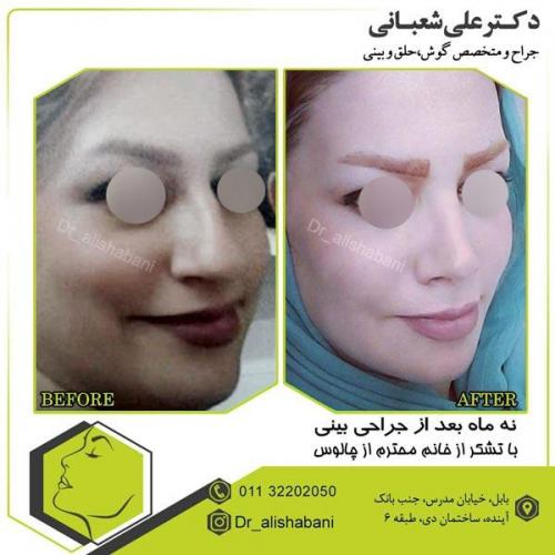 جراحی بینی 3