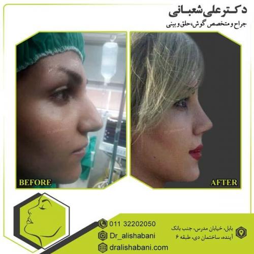جراحی بینی 66