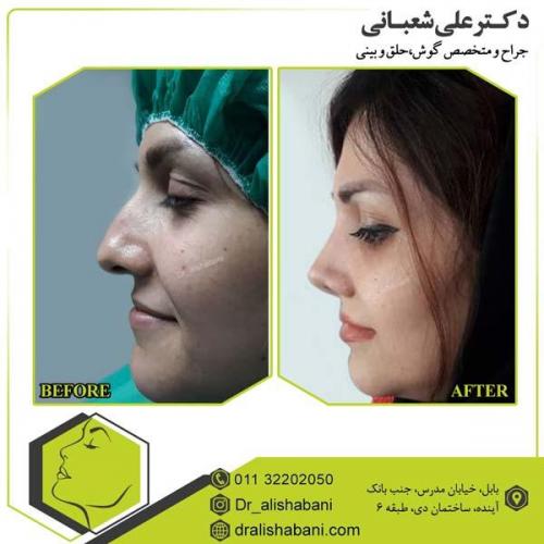 جراحی بینی 70