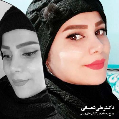 جراحی بینی 76