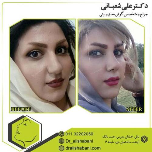 جراحی بینی 79