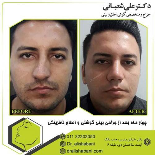 جراحی بینی 82
