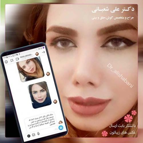 جراحی بینی 83