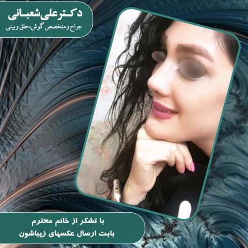 جراحی بینی 84