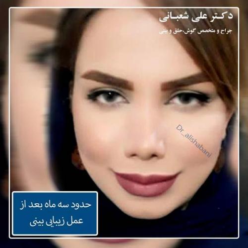 جراحی بینی 86
