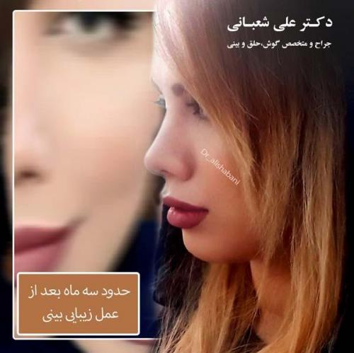 جراحی بینی 88