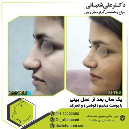 جراحی بینی 92