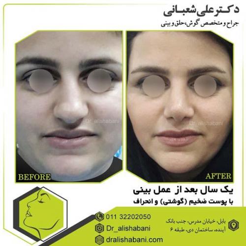 جراحی بینی 93