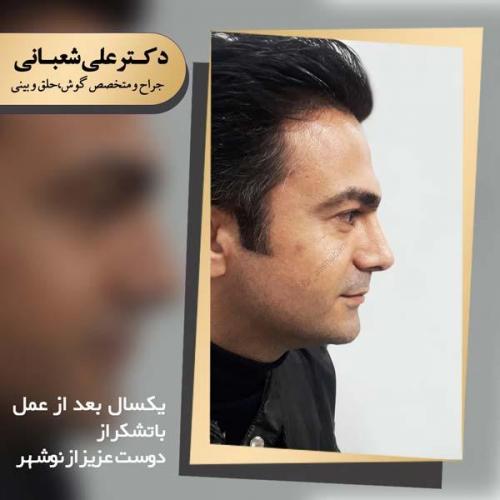 جراحی بینی 95