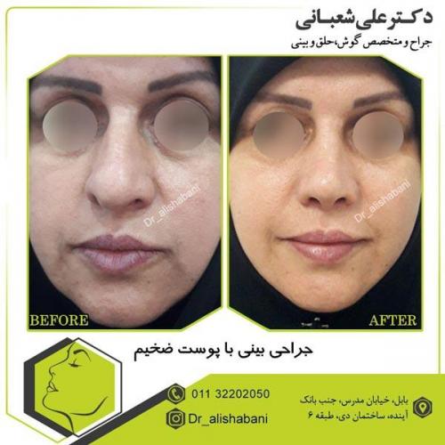 عمل بینی 1