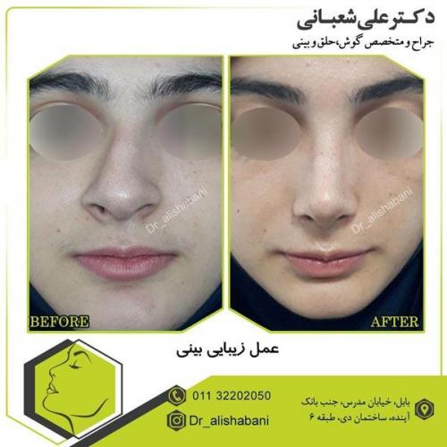عمل بینی 11