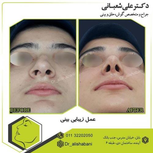 عمل بینی 12