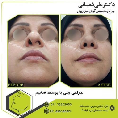 عمل بینی 2