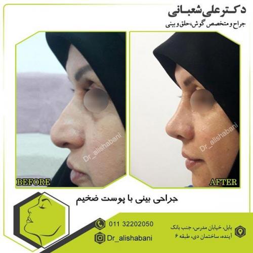 عمل بینی 3
