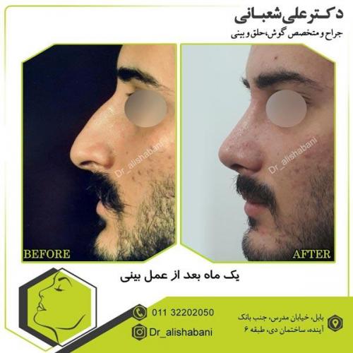 عمل بینی 5